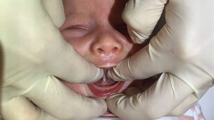 Das verkürzte Zungen- und Lippenbändchen